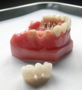 dental bridge and crowns