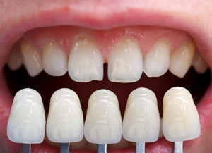 veneers shade selection