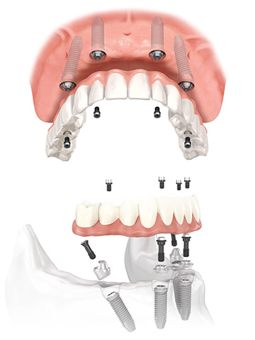 all-on-4-upper-lower illustration